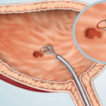 Atezolizumab, prima imunoterapie  pentru cancerul de vezică urinară avansat, intră în programele naţionale ale mai multor ţări din vestul Europei