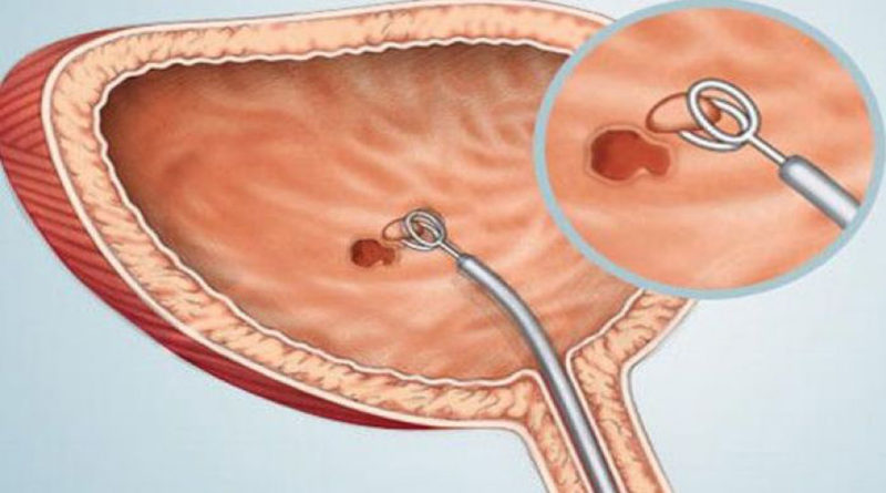 Atezolizumab, prima imunoterapie  pentru cancerul de vezică urinară avansat, intră în programele naţionale ale mai multor ţări din vestul Europei