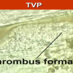 Cele mai întâlnite boli care nu prezintă simptome