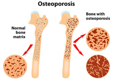 O nouă moleculă, Romosozumab, pentru reducerea riscului de fractură la femeile aflate în postmenopauză, având risc crescut de osteoporoză