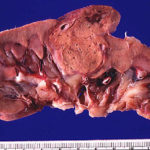 Recomandare NICE pozitivă pentru Lenvatinib pentru tratamentul carcinomului renal avansat