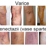Patru metode pentru reducerea varicelor