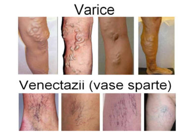 Patru metode pentru reducerea varicelor