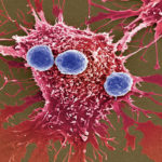 CAT – T, o descoperire excepțională a cercetătorilor de la Simmons Cancer Center