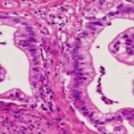Noi descoperiri privind cancerul pancreatic