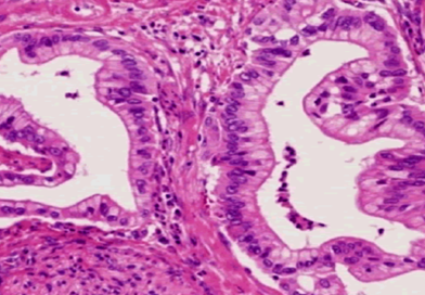 Noi descoperiri privind cancerul pancreatic
