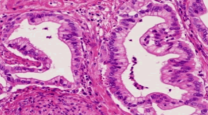 Noi descoperiri privind cancerul pancreatic
