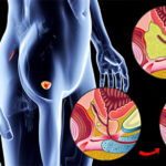 Cartografierea cancerului de prostată ar putea determina un tratament mai eficient