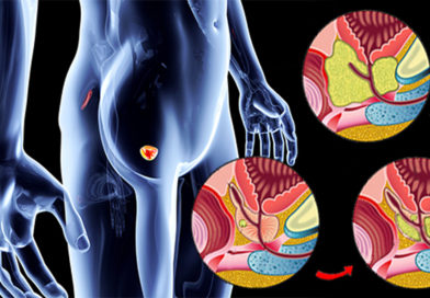 Cartografierea cancerului de prostată ar putea determina un tratament mai eficient