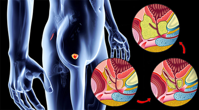Cartografierea cancerului de prostată ar putea determina un tratament mai eficient