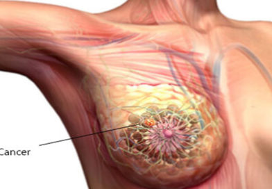 STUDIU DESPRE FOLOSIREA CHIMIOTERAPIEI ÎN CANCERUL DE SÂN