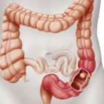 Legătura dintre nivelul ridicat de colesterol și cancerul de colon