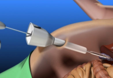 TEHNICĂ MEDICALĂ INOVATIVĂ PENTRU CHIRURGIA VEZICII BILIARE