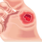 O nouă speranță în tratarea rănilor diabetice