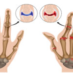 DIETA BOLNAVILOR DE POLIARTRITĂ REUMATOIDĂ