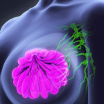 Medicament utilizat pentru tratarea osteoporozei, benefic în tratarea cancerului de sân