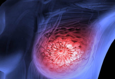 Tratamente vechi, abordări noi în tratarea cancerului mamar triplu negativ