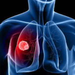 O nouă tehnică ar putea ajuta la tratarea fibrozei pulmonare