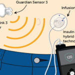 A fost inventat primul pancreas artificial din lume