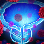 S-a descoperit o nouă genă implicată în dezvoltarea cancerului de prostată