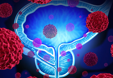 S-a descoperit o nouă genă implicată în dezvoltarea cancerului de prostată