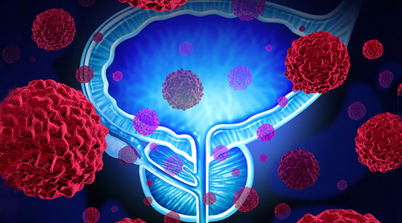 S-a descoperit o nouă genă implicată în dezvoltarea cancerului de prostată