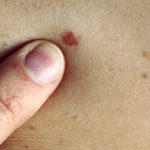 Iată la ce tip de cancer ești predispus dacă ai suferit un transplant de organe!