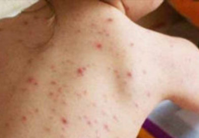 Alertă medicală: noi cazuri de rujeolă în România