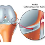 Cum se repară ruptura de ligament