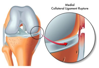 Cum se repară ruptura de ligament