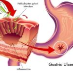 Atenţie la ulcer! 10 semnale de alarmă