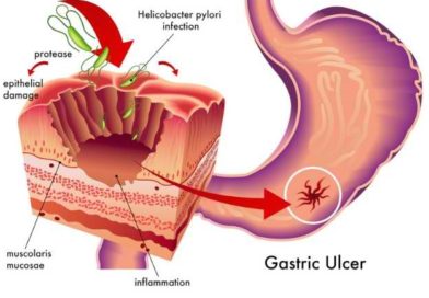 Atenţie la ulcer! 10 semnale de alarmă