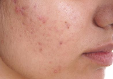 Doua remedii fara medicamente pentru acnee