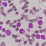 Enzima care poate genera apariția leucemiei