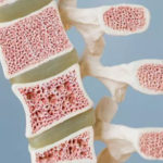 Noi speranțe pentru pentru pacienții care suferă de cancer al măduvei osoase