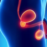 Tehnologie revoluționară de detectare a cancerului de prostată