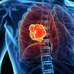 Semaphorin 7a, proteina cu un rol important în dezvoltarea cancerului pulmonar
