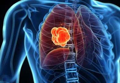 Semaphorin 7a, proteina cu un rol important în dezvoltarea cancerului pulmonar