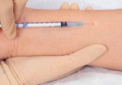 Testul de piele care poate detecta prezența unor agenți infecțioși