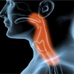 Metoda de detectare precoce a cancerului de esofag cu ajutorul unui burete