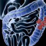 Află totul despre bacteria care provoacă apariția cancerului de colon!