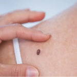 A fost descoperit modul în care poate fi tratat cancerul de piele