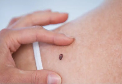 A fost descoperit modul în care poate fi tratat cancerul de piele