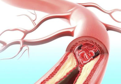 Molecula CD69, rol esențial în diagosticarea precoce a aterosclerozei