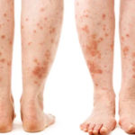 Iată care este legătura dintre psoriazis și afecțiunile intestinale!