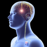 WAND, dispozitivul creat pentru persoanele cu afecțiuni neurologice