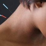 Acupunctura, benefică pentru femeile aflate la menopauză