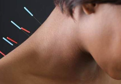 Acupunctura, benefică pentru femeile aflate la menopauză