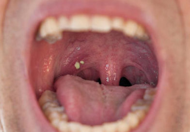 S-a constatat că adenoizii și amigdalele nu se micşorează semnificativ în decursul adolescenței