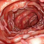 Compusul care poate inhiba activitatea genei responsabilă de boala inflamatorie intestinală
